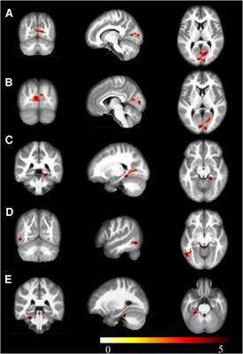 Sports promote brain evolution: a resting-state fMRI study of volleyball athlete